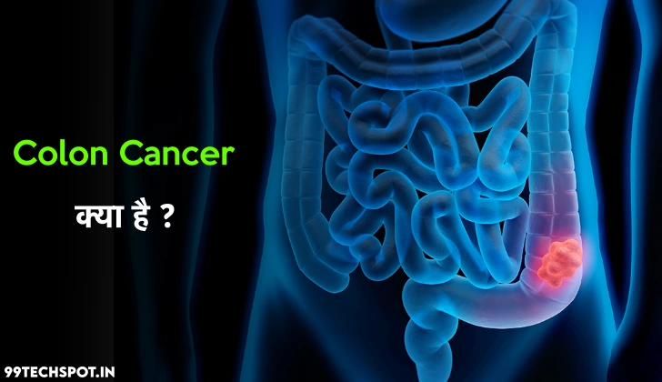 Colon Cancer क्या है 